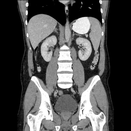 Closed-loop small bowel obstruction (Radiopaedia 73713-84509 C 76).jpg