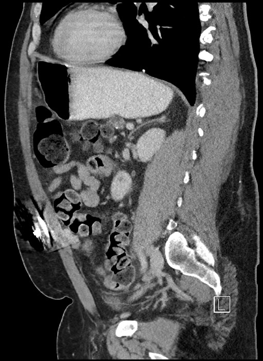 Closed loop obstruction - internal hernia into nephrectomy bed (Radiopaedia 59867-67320 C 31).jpg
