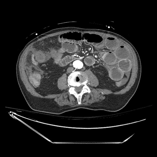 Closed loop obstruction due to adhesive band, resulting in small bowel ischemia and resection (Radiopaedia 83835-99023 B 82).jpg
