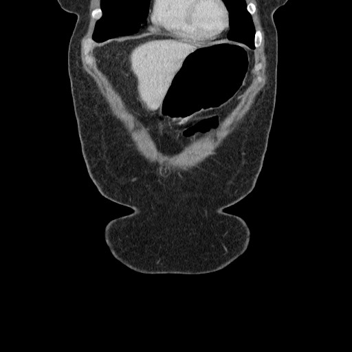 Closed loop small bowel obstruction (Radiopaedia 65403-74451 B 24).jpg