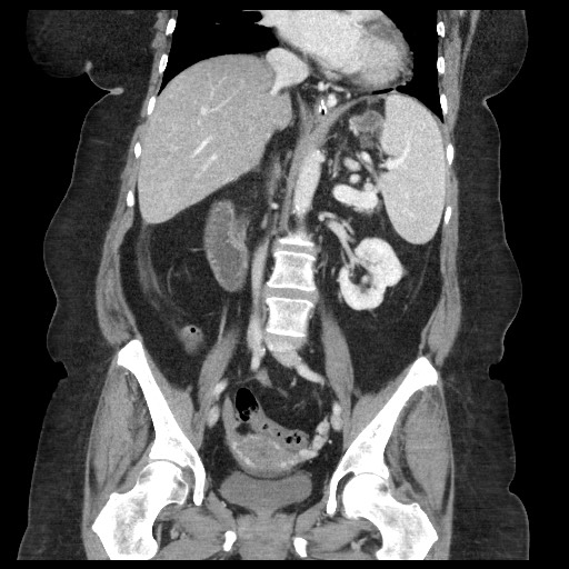 Closed loop small bowel obstruction - internal hernia (Radiopaedia 65402-74450 B 62).jpg