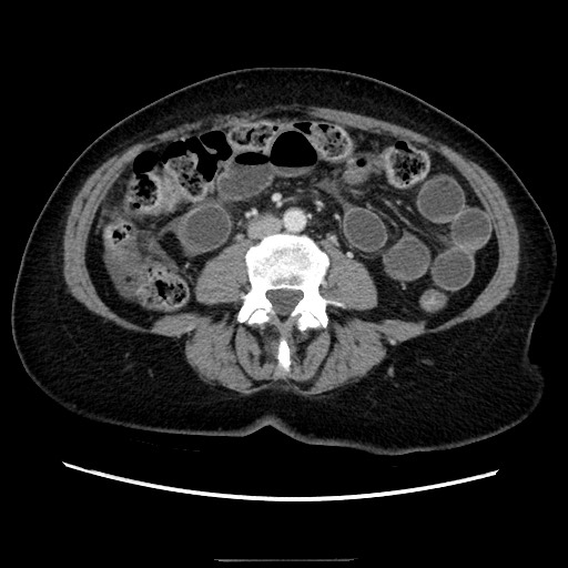 Closed loop small bowel obstruction due to adhesive bands - early and late images (Radiopaedia 83830-99015 A 90).jpg