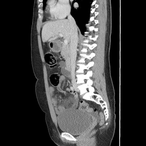 Closed loop small bowel obstruction due to trans-omental herniation (Radiopaedia 35593-37109 C 30).jpg