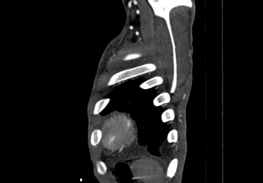 Coarctation of aorta with aortic valve stenosis (Radiopaedia 70463-80574 B 230).jpg