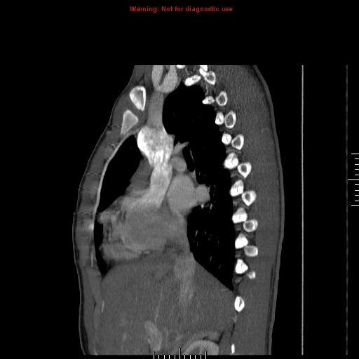 Coarctation of the aorta (Radiopaedia 9434-10118 B 19).jpg