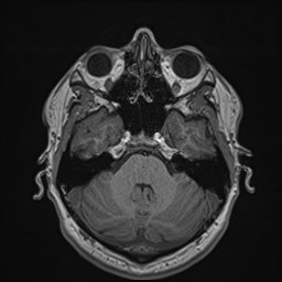 File:Cochlear incomplete partition type III associated with hypothalamic hamartoma (Radiopaedia 88756-105498 Axial T1 64).jpg