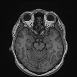 Cochlear incomplete partition type III associated with hypothalamic hamartoma (Radiopaedia 88756-105498 Axial T1 82).jpg