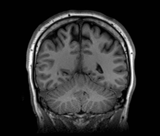Cochlear incomplete partition type III associated with hypothalamic hamartoma (Radiopaedia 88756-105498 Coronal T1 22).jpg