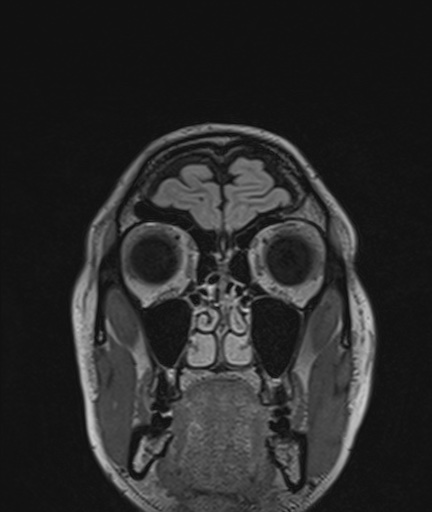 Colloid cyst (Radiopaedia 73154-83877 Coronal FLAIR 6).jpg