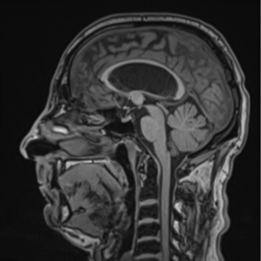 File:Colloid cyst of the third ventricle (Radiopaedia 86571-102662 Sagittal T1 39).png