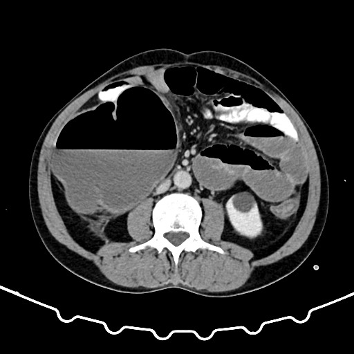 Colocolic intussusception due to large lipoma (Radiopaedia 68773-78482 A 93).jpg