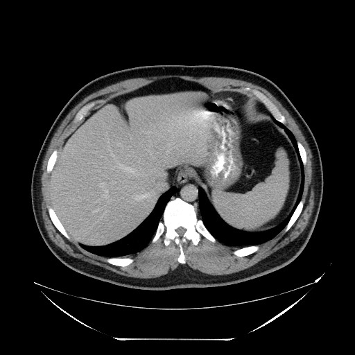 File:Colocolic intussusception due to lipoma (Radiopaedia 73712-84508 Axial 31).jpg