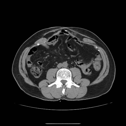 File:Colocutaneous fistula in Crohn's disease (Radiopaedia 29586-30093 D 6).jpg