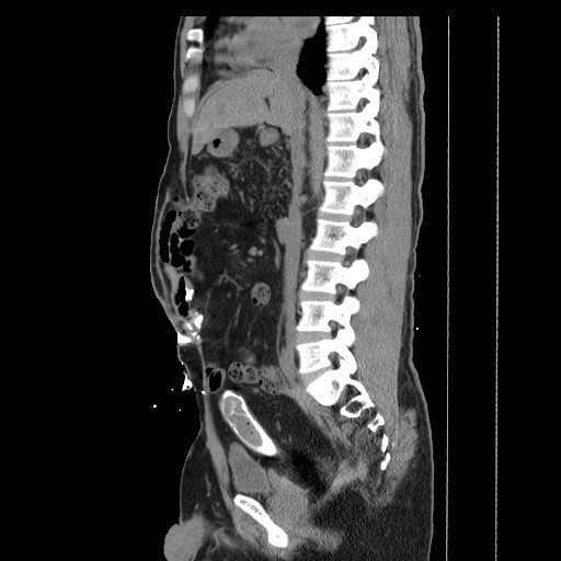 Colocutaneous fistula in Crohn's disease (Radiopaedia 29586-30093 F 11).jpg