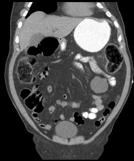 Colon adenocarcinoma - splenic flexure (Radiopaedia 34143-35406 B 24).png