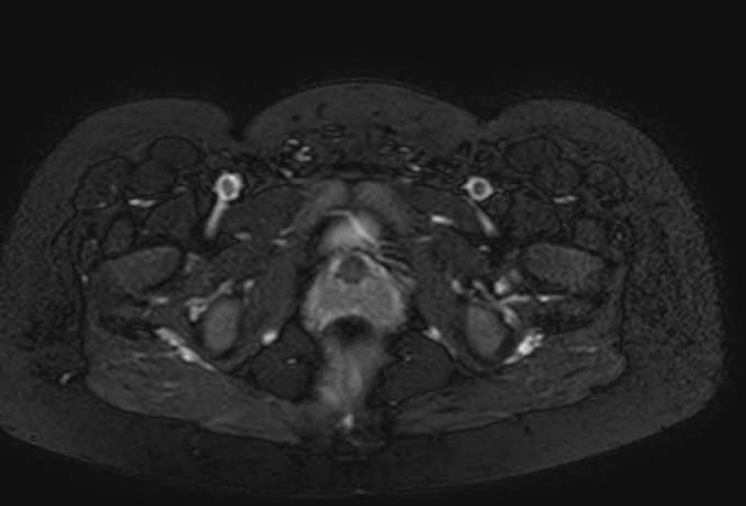 Colon adenocarcinoma with Krukenberg tumors, advanced pregnancy (Radiopaedia 67279-76645 Axial T2 SPAIR 3).jpg