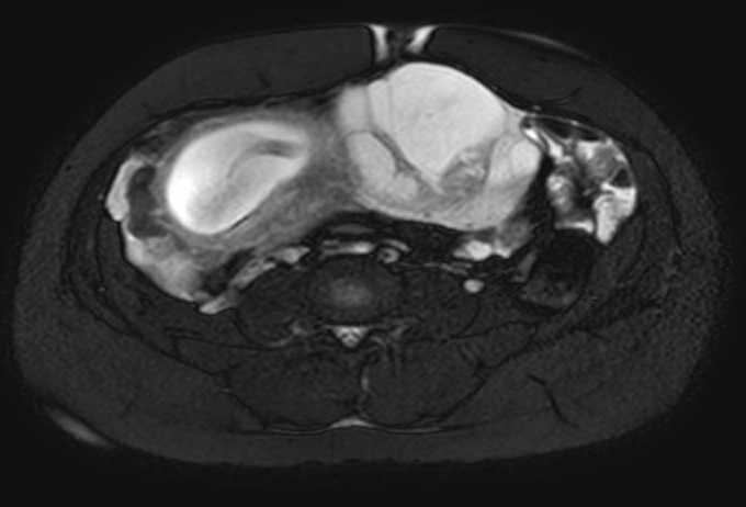 File:Colon adenocarcinoma with Krukenberg tumors, advanced pregnancy (Radiopaedia 67279-76645 Axial T2 SPAIR 35).jpg