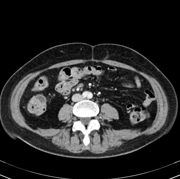 Colon carcinoma with hepatic metastases (Radiopaedia 29477-29961 A 66).jpg