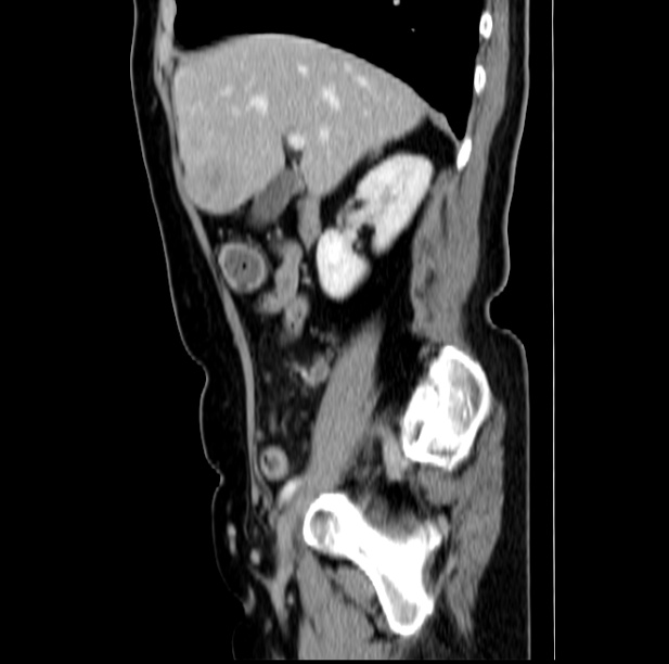 Colon carcinoma with hepatic metastases (Radiopaedia 29477-29961 C 18).jpg