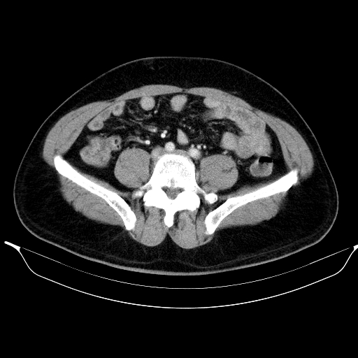 Colonic lipoma with colo-colic intussusception (Radiopaedia 58944-66200 A 44).jpg