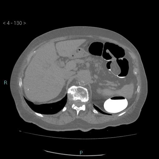 File:Colonic lipomas (Radiopaedia 49137-54244 Axial bone window 58).jpg