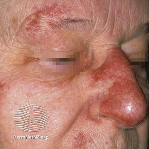 Cutaneous lupus erythematosus (DermNet NZ immune-lupus-erythematosus-2520).jpg
