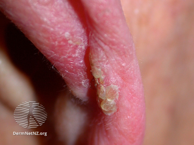 Intraepidermal carcinoma (DermNet NZ lesions-scc-in-situ-2957).jpg