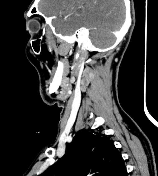 File:Nasopharyngeal carcinoma - infiltrating the clivus (Radiopaedia 62583-70875 C 14).jpg