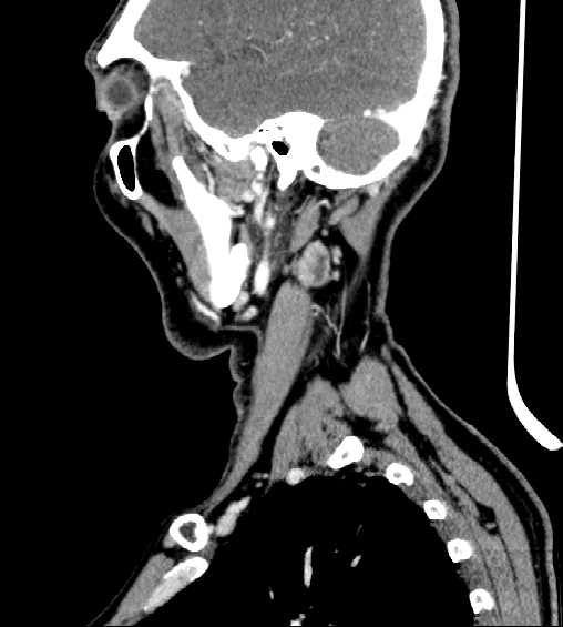 File:Nasopharyngeal carcinoma - infiltrating the clivus (Radiopaedia 62583-70875 C 42).jpg