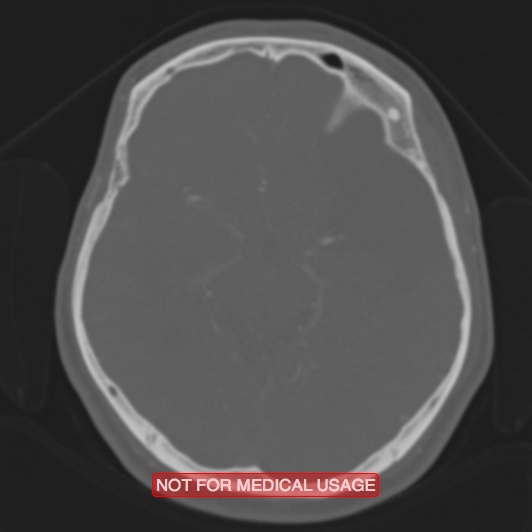 File:Nasopharyngeal carcinoma recurrence - skull base destruction (Radiopaedia 29107-29490 Axial bone window 59).jpg