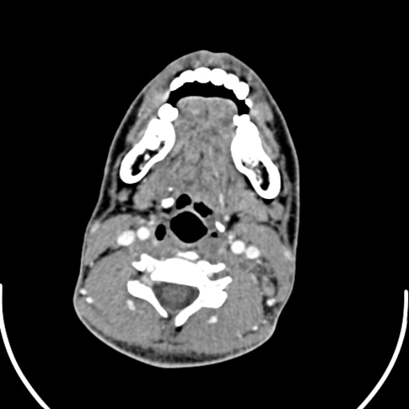 Nasopharyngeal carcinoma with skull base invasion (Radiopaedia 53415-59705 A 122).jpg