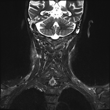 Nasopharyngeal carcinoma with skull base invasion (Radiopaedia 59258-66600 Coronal T2 fat sat 4).jpg