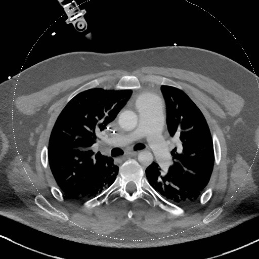 Neck CT angiogram (intraosseous vascular access) (Radiopaedia 55481-61945 B 32).jpg