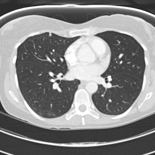 Necrobiotic pulmonary nodules - Crohn disease (Radiopaedia 20723-20631 Axial lung window 78).jpg