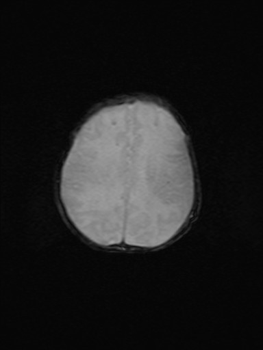 File:Neonatal hypoxic-ischemic encephalopathy (Radiopaedia 41406-44277 Axial Gradient Echo 7).jpg