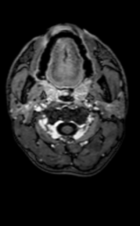 Neuro-Behçet disease (Radiopaedia 90112-107294 Axial T1 C+ 221).jpg