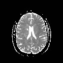 File:Neuro-Behcet's disease (Radiopaedia 21557-21505 Axial ADC 14).jpg