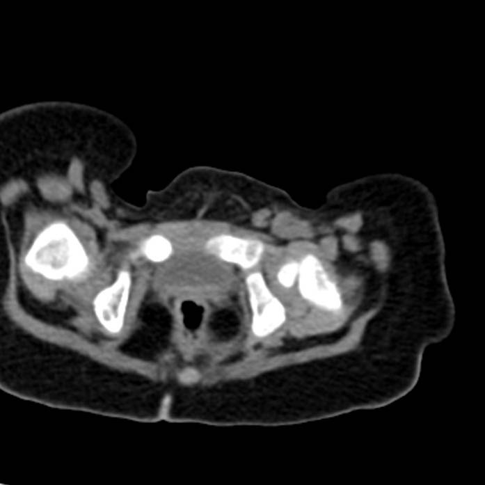 Neuroblastoma with skull metastases (Radiopaedia 30326-30960 Axial non-contrast 61).jpg