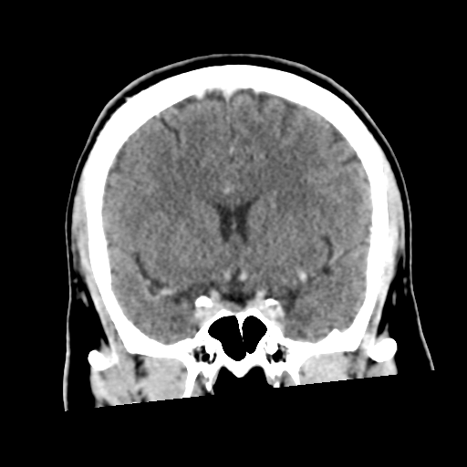 Neurocysticercosis - granular nodular (Radiopaedia 42786-45957 Coronal C+ 27).png