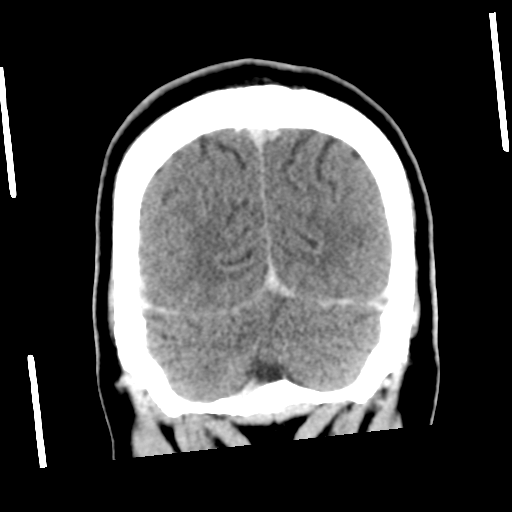 Neurocysticercosis - granular nodular (Radiopaedia 42786-45957 Coronal C+ 54).png