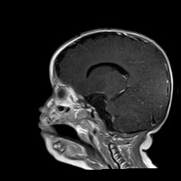 File:Neurofibromatosis type 1 (Radiopaedia 30089-30671 Sagittal T1 C+ 6).jpg