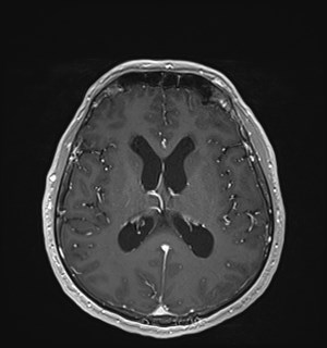 Neurofibromatosis type 2 (Radiopaedia 79097-92049 Axial T1 C+ 113).jpg