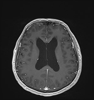 Neurofibromatosis type 2 (Radiopaedia 79097-92049 Axial T1 C+ 122).jpg