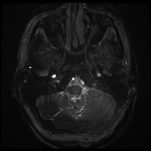 Neurofibromatosis type 2 - bilateral acoustic neuromata (Radiopaedia 40060-42566 Axial FIESTA 7).png