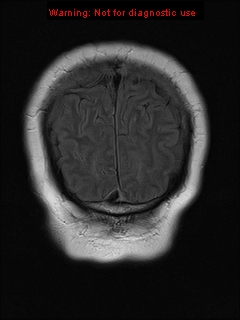 File:Neuroglial cyst (Radiopaedia 10713-11184 Coronal FLAIR 4).jpg