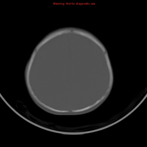 File:Non-accidental injury - bilateral subdural with acute blood (Radiopaedia 10236-10765 Axial bone window 18).jpg