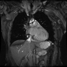 File:Non-compaction of the left ventricle (Radiopaedia 38868-41062 Coronal SSFP 2D FS 7).jpg
