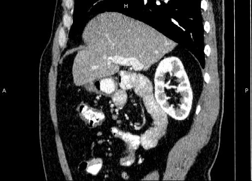 Non-syndromic pancreatic endocrine tumor (Radiopaedia 86958-103178 E 35).jpg