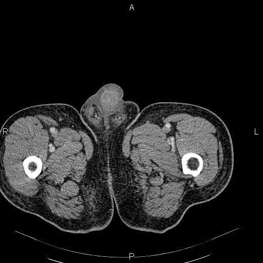 File:Non Hodgkin lymphoma in a patient with ankylosing spondylitis (Radiopaedia 84323-99621 B 74).jpg