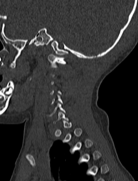 File:Normal CT cervical spine - pediatric (Radiopaedia 52549-58462 Sagittal bone window 22).jpg
